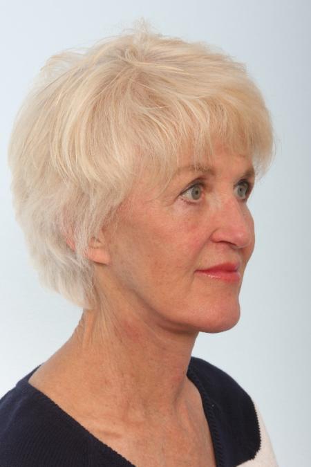 After image 2 Case #127061 - Facelift