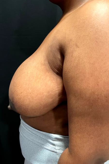 Before image 3 Case #127516 - Breast Reduction