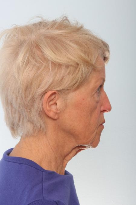 Before image 3 Case #127061 - Facelift