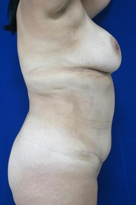 After image 3 Case #127131 - Case 3 - Lipoabdominoplasty & Breast Implants