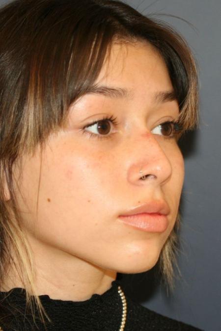 Before image 2 Case #126961 - Female Rhinoplasty