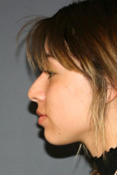 Before image 3 Case #126961 - Female Rhinoplasty