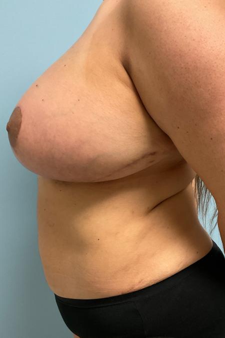 After image 3 Case #127806 - 48 y.o. Female w/ Breast Revision+ Breast Lift