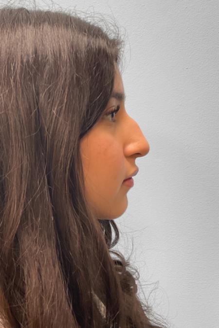 Before image 3 Case #127656 - Rhinoplasty