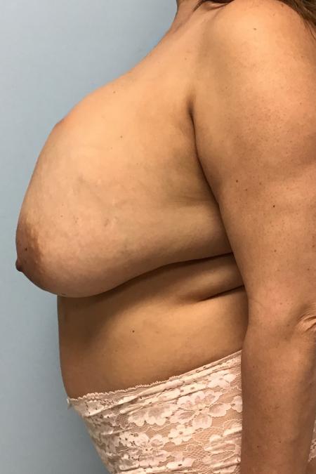 Before image 3 Case #127806 - 48 y.o. Female w/ Breast Revision+ Breast Lift