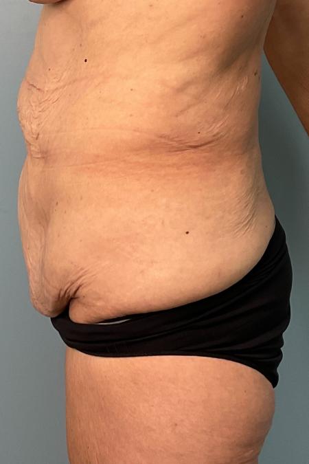 Before image 3 Case #127556 - Tummy Tuck + Lipo of Flanks/Thighs + Bra Line Lift