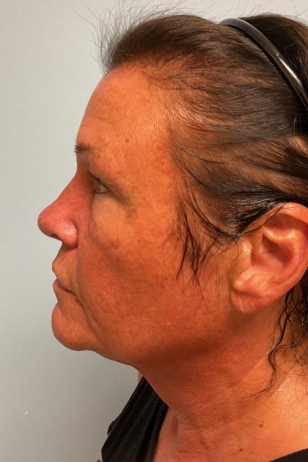 Before image 2 Case #128336 - 59 y.o. female w/ Neck & Face Lift 