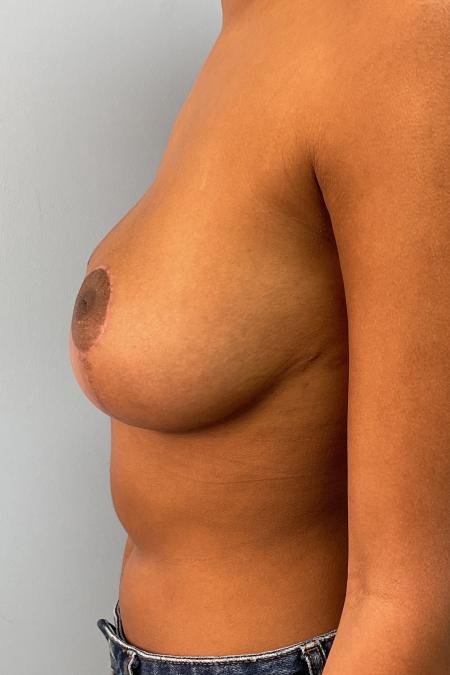 After image 3 Case #128546 - 22 y.o. female with Breast Reduction