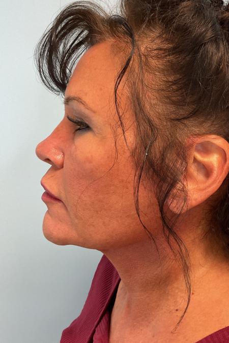 After image 2 Case #128336 - 59 y.o. female w/ Neck & Face Lift 