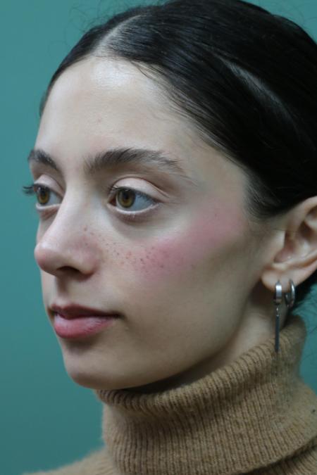 After image 2 Case #128876 - Primary Rhinoseptoplasty