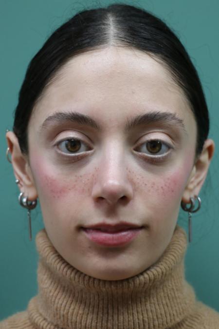 After image 1 Case #128876 - Primary Rhinoseptoplasty