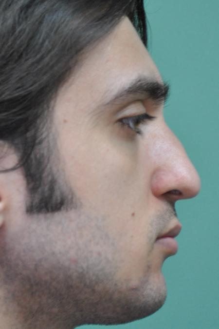 Before image 4 Case #128871 - Primary Septorhinoplasty