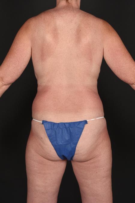 Before image 4 Case #128866 - Mommy Makeover - Breast Implant Removal, Mastopexy