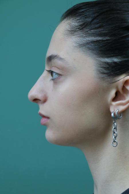 Before image 5 Case #128876 - Primary Rhinoseptoplasty