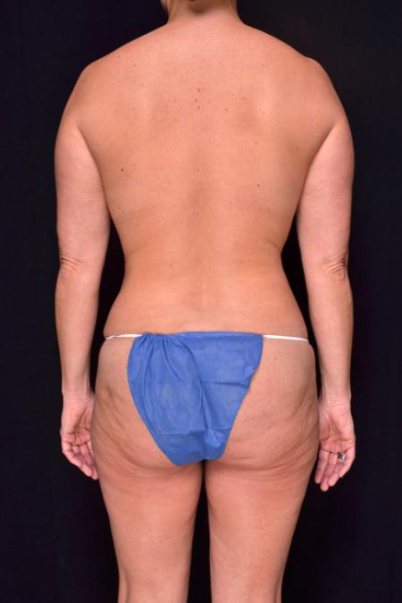 After image 4 Case #128941 - Mommy Makeover - Augmentation Mastopexy
