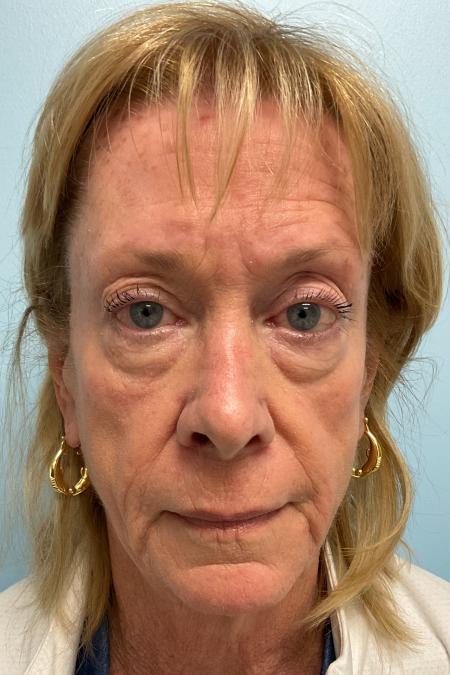 Before image 2 Case #129006 - 71 y.o. female with Botox and Filler