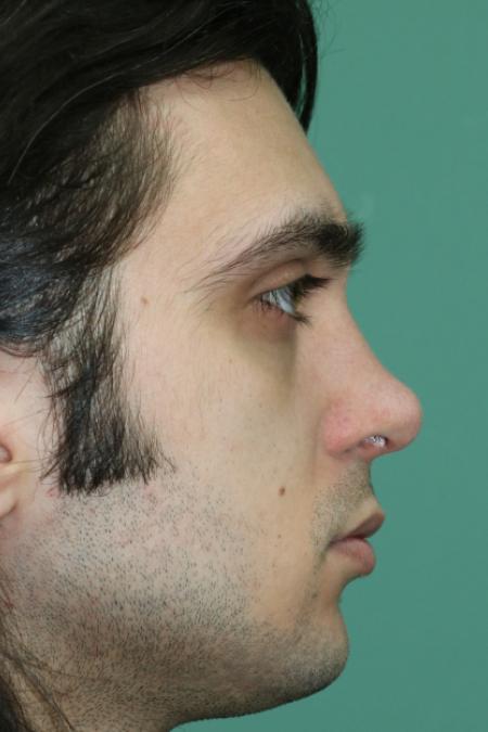 After image 4 Case #128871 - Primary Septorhinoplasty