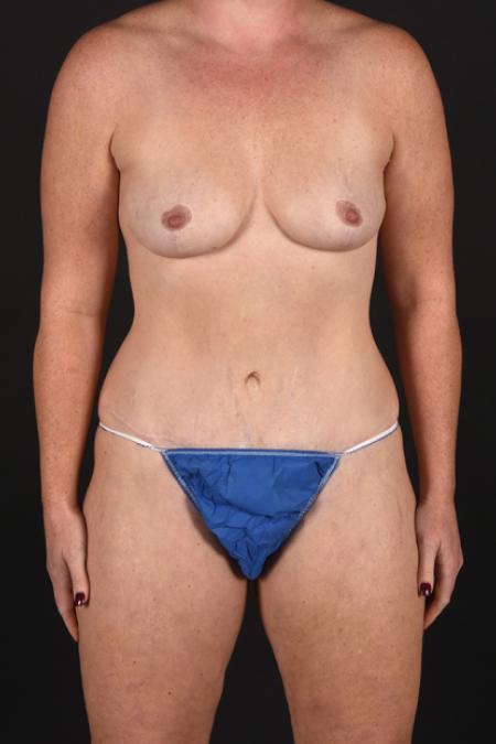 After image 1 Case #128886 - Mommy Makeover - Mastopexy with Abdominoplasty