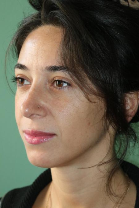 After image 3 Case #128881 - Primary Rhinoseptoplasty