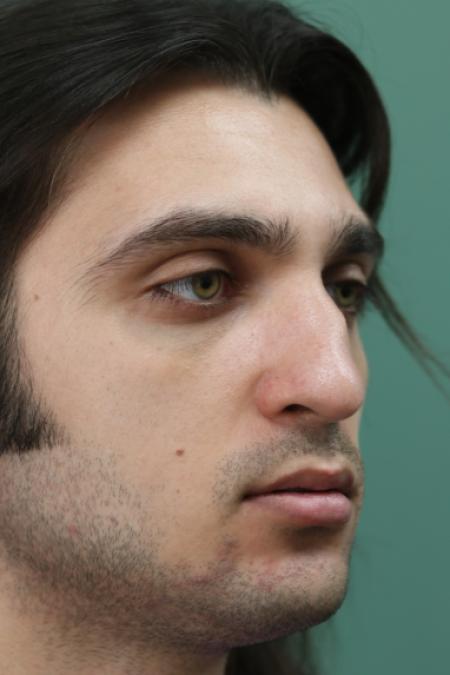 Before image 2 Case #128871 - Primary Septorhinoplasty