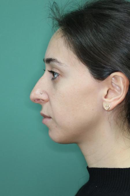 Before image 4 Case #128881 - Primary Rhinoseptoplasty