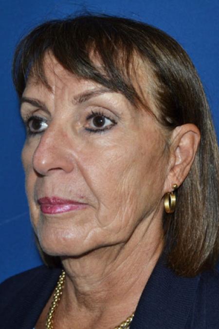 Before image 2 Case #129041 - Facial Rejuvenation