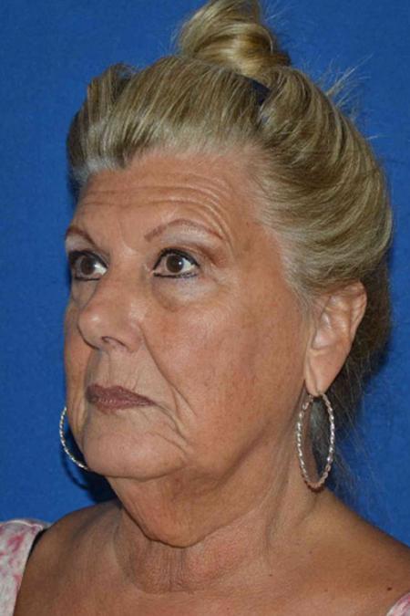 Before image 2 Case #129046 - Face lift