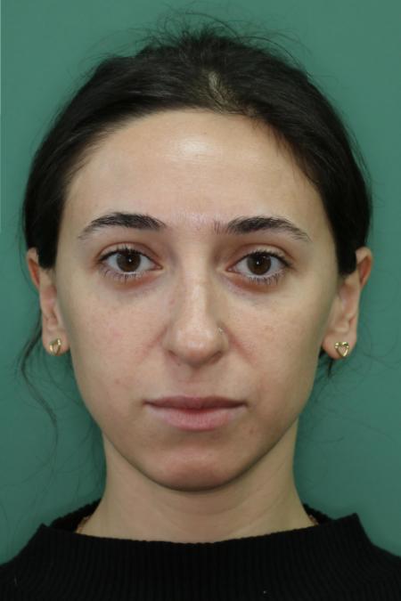 Before image 1 Case #128881 - Primary Rhinoseptoplasty