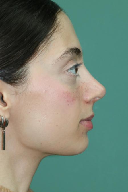 After image 4 Case #128876 - Primary Rhinoseptoplasty