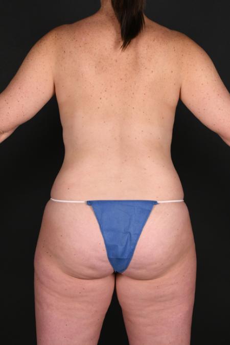 Before image 4 Case #128936 - Mommy Makeover - Augmentation Mastopexy 