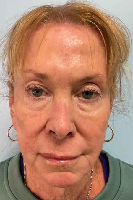 After image 2 Case #129006 - 71 y.o. female with Botox and Filler