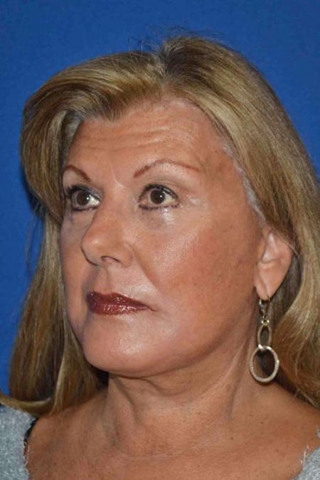 After image 2 Case #129046 - Face lift