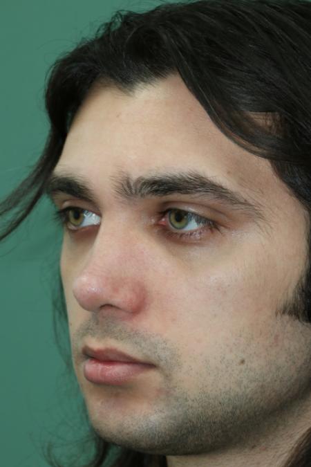 After image 3 Case #128871 - Primary Septorhinoplasty