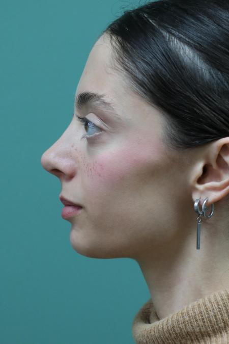 After image 5 Case #128876 - Primary Rhinoseptoplasty