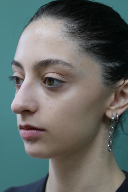 Before image 2 Case #128876 - Primary Rhinoseptoplasty