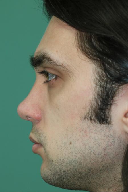 After image 5 Case #128871 - Primary Septorhinoplasty