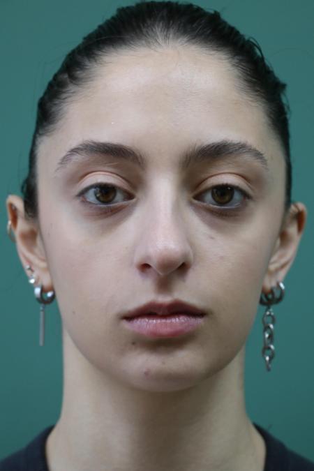 Before image 1 Case #128876 - Primary Rhinoseptoplasty