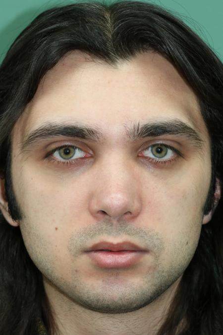 After image 1 Case #128871 - Primary Septorhinoplasty