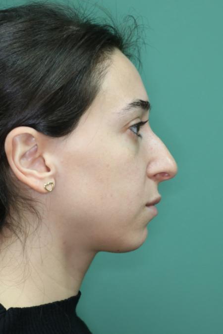 Before image 5 Case #128881 - Primary Rhinoseptoplasty
