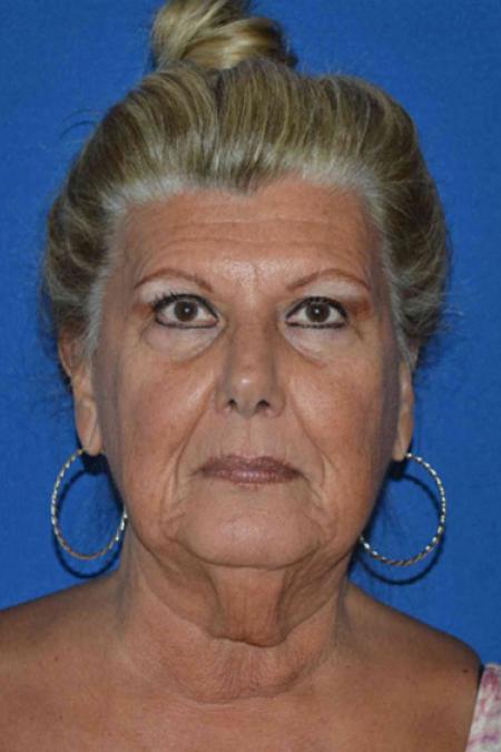 Before image 1 Case #129046 - Face lift