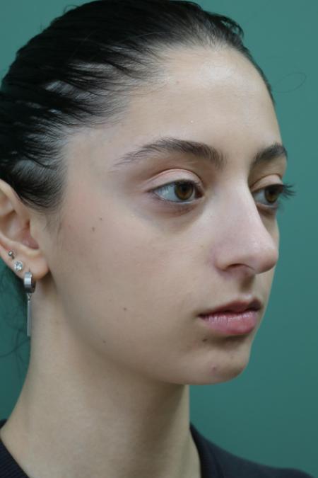 Before image 3 Case #128876 - Primary Rhinoseptoplasty