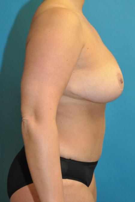 After image 3 Case #130156 - Mommy Makeover