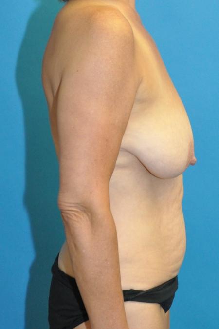 Before image 3 Case #130141 - Mommy Makeover