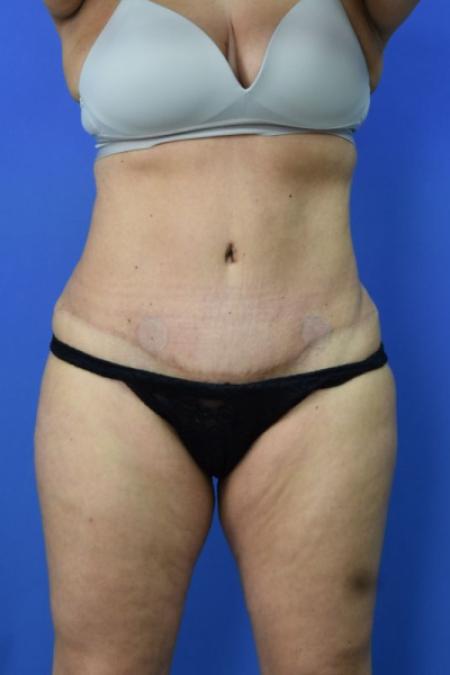 After image 1 Case #129716 - Tummy tuck with BBL