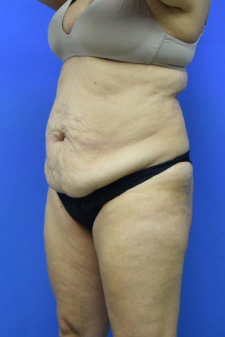 Before image 2 Case #129716 - Tummy tuck with BBL