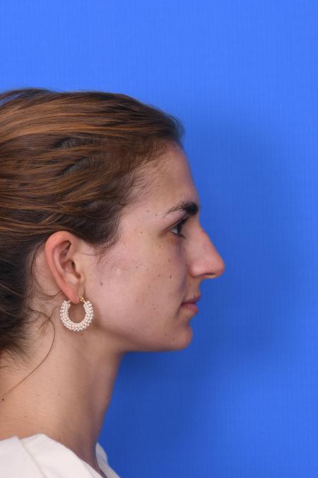Before image 3 Case #129951 - RHINOPLASTY