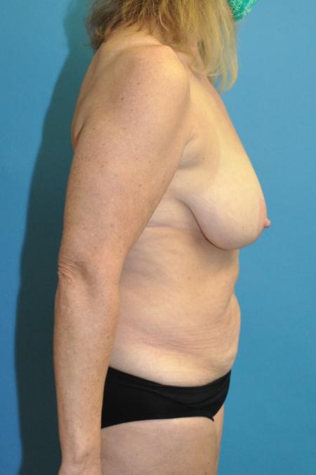 Before image 3 Case #130151 - Mommy Makeover