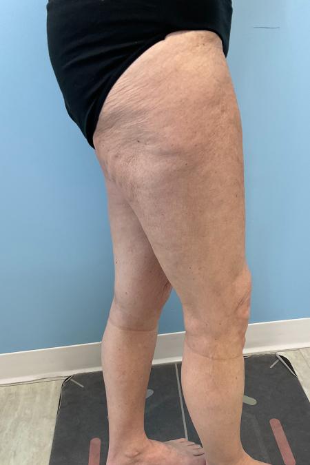 After image 3 Case #129816 - 68 y.o female with Thigh Lift and Lipo