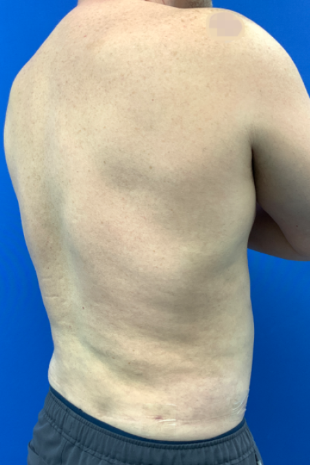 After image 3 Case #129431 - Liposuction