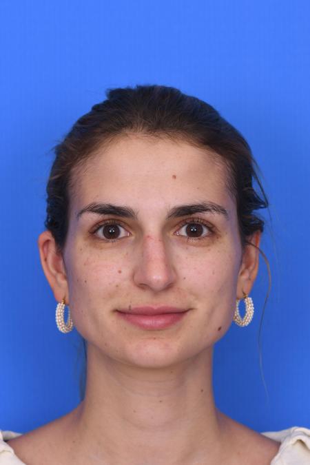 Before image 1 Case #129951 - RHINOPLASTY